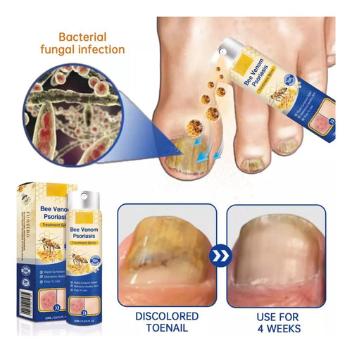 Spray For El Cuidado De La Psoriasis Furzero Psoriaheal Con