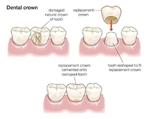 Coronas Frontales Provisionales Para Dientes De Porcelana