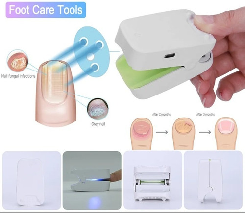 Láser Eliminación Para Hongos Uñas (onicomicosis)