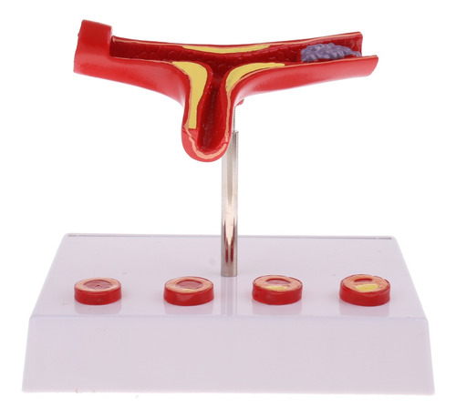 Modelo De Vascular De Trombo De Aterosclerosis De Vaso