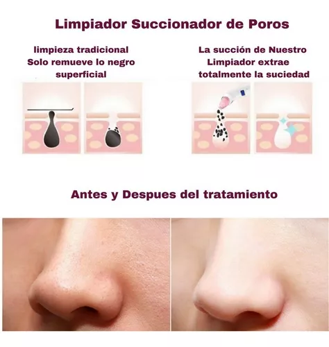 Limpiador Facial Poros Succión Puntos Negros Espinillas Acne