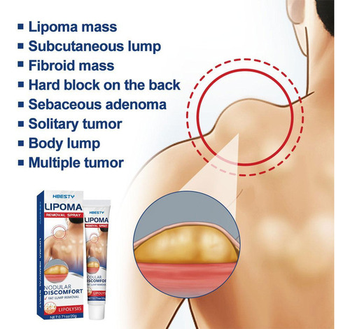 - Crema Para Eliminar Lipomas, Crema Limpiadora De Lipomas.