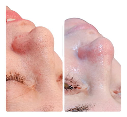 Limpieza Facial Profunda En Sáenz Peña, 3 De Febrero