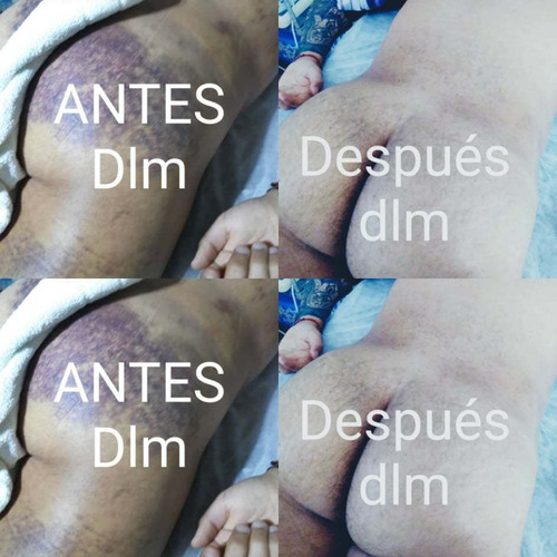 Imagen 5 de 10 de Depilación Masculina-masajes-drenaje Linfático Vodder