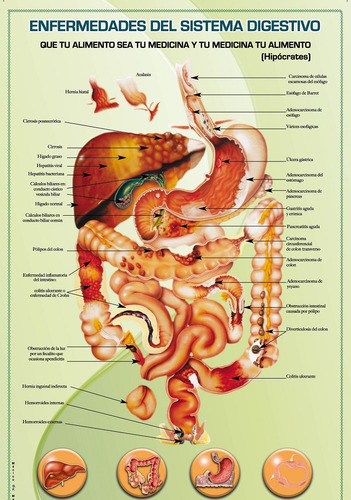 Posters Enfermedades Del Sistema Digestivo