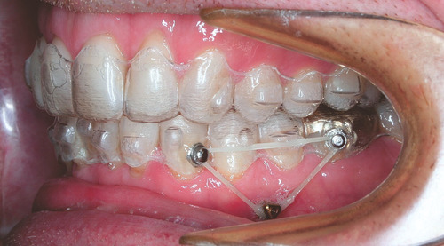 Imagen 2 de 2 de Reliance Bond Aligner Jeringa 1,4gr