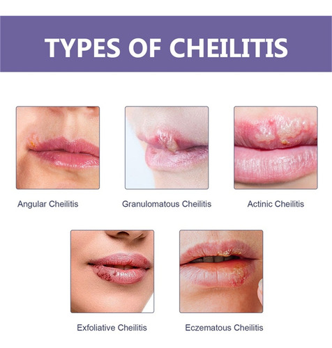 Parches Suavizantes Para Herpes Labial Parche Curativo Discr