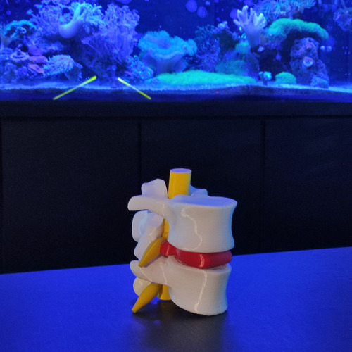 Modelo Anatômico Hérnia Disco Coluna Vertebral 3d