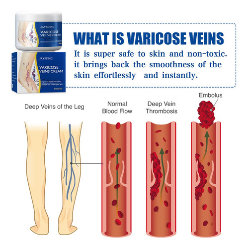 3×crema For Venas Varicosas X Spider Varique Venin Treat
