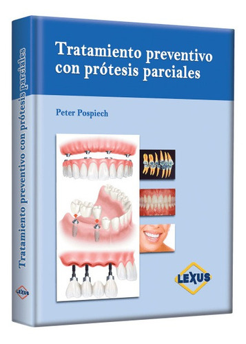 Tratamiento Preventivo Con Prótesis Parciales / Pospiech