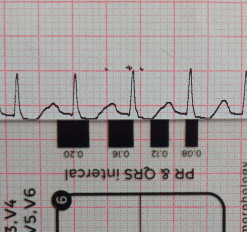 Regla 7 Pasos Para Lectura De Ecg Rcp Interpretación