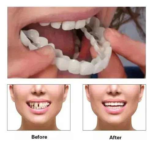 I Carillas De Dientes Postizos De Sonrisa Superior Inferior