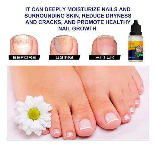 Gotas De Plantas Para El Cuidado De Las Uñas, Aceite De