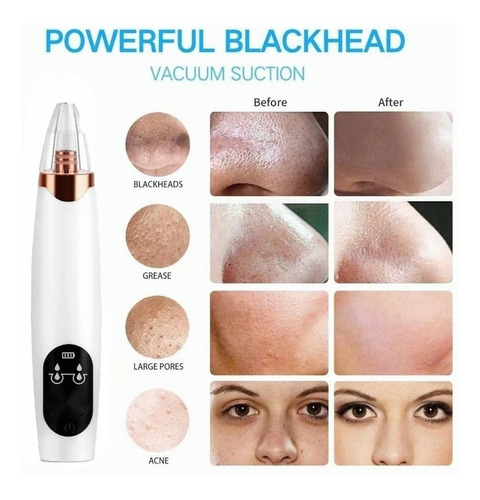 Depurador Facial De 3 Kits, Ems, Eliminación Del Acné