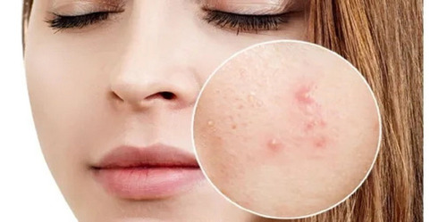 Limpeza De Pele Sabonete Granado Enxofre 90g C/6 Antiacne