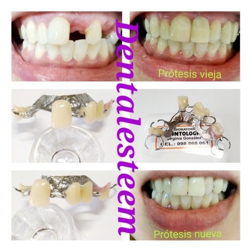 Imagen 3 de 5 de Prótesis Dentales Dentista Placas De Contencion Y Bruxismo