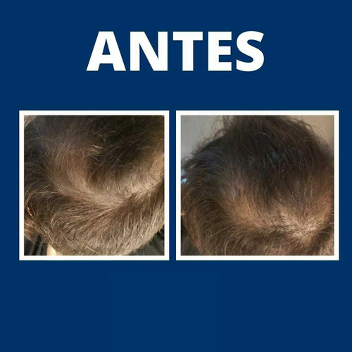 Imagen 2 de 5 de Mesoterapia Capilar