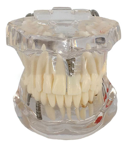 Modelo De Diente: Dientes Implantados, Modelo Dental, Repara