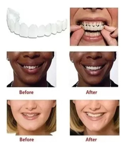 Facetas De Dentes Postiços De Sorriso Superior/inferior