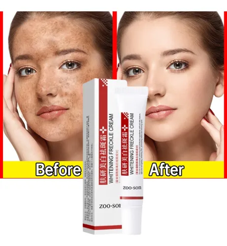 Creme Facial Clareador Melasma Acne Sardas Manchas Escuras Moment...