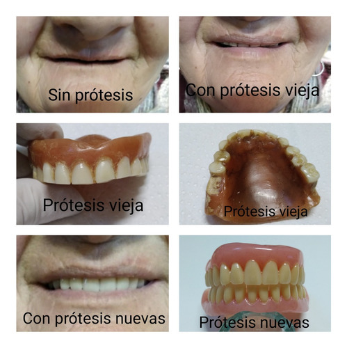 Imagen 3 de 5 de Prótesis Dentales - Dentista - Placas Contencion Y Bruxismo