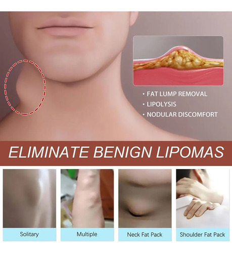 Crema Para Eliminar Bultos Subcutáneos Lipoma Cream, 20 G