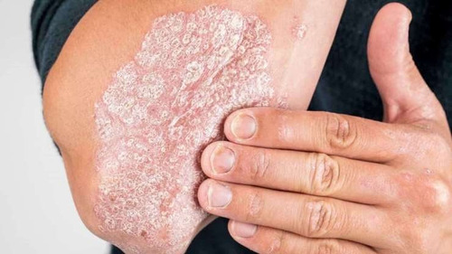 Jabon Para Psoriasis