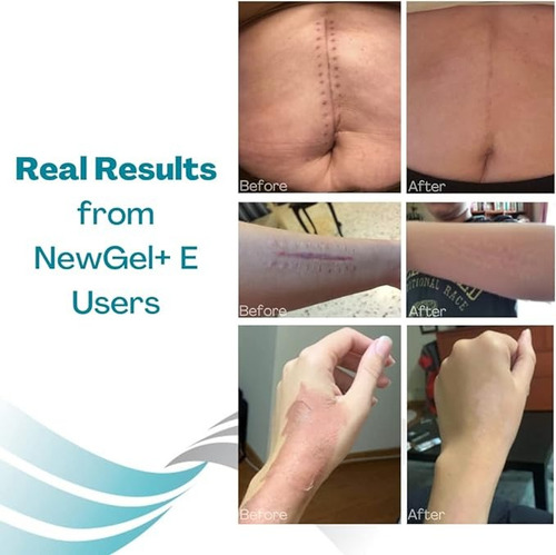Gel Cicatrizante Con Vitamina E New Gel Avanzado Cicatrices Fragancia 2