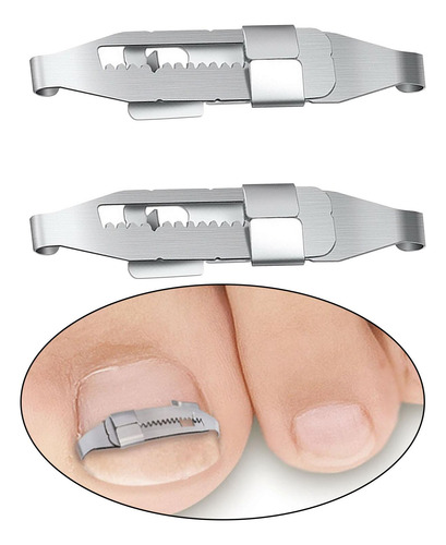 2 Uds Herramientas De Corrección De Uñas Encarnadas Clips