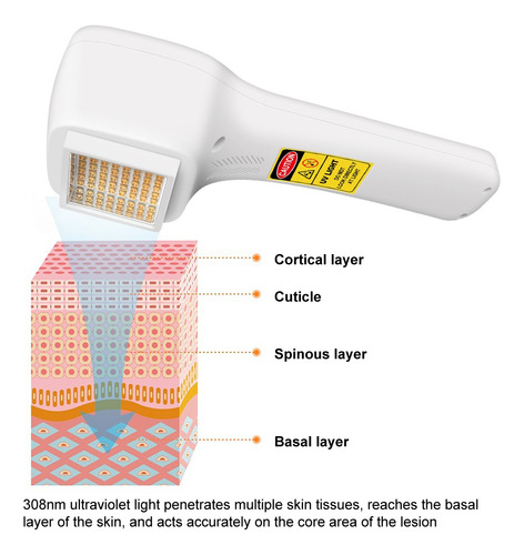 Terapia Ultravioleta Con Lámpara Láser Portátil De 308 Nm