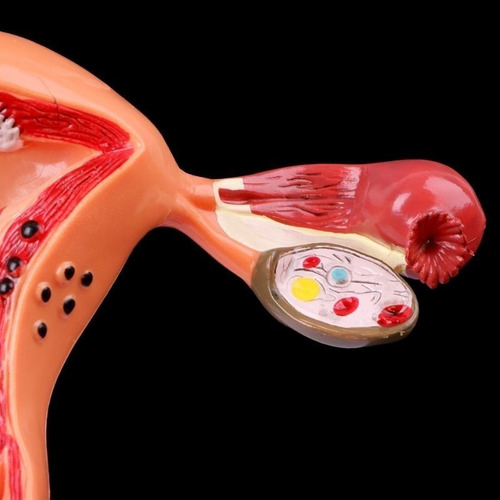 Modelo Anatómico De Ovario Uterino Con Patologías