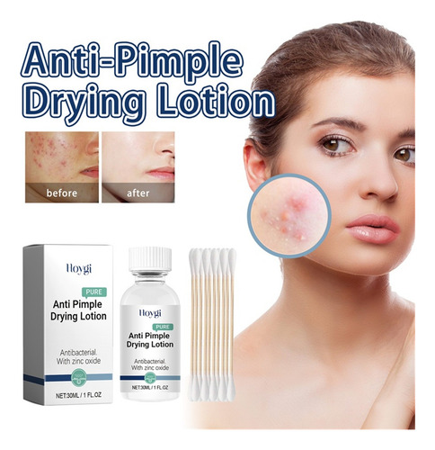 Loción Secante J Pimple De 30 Ml I Con Loción De Óxido I Par