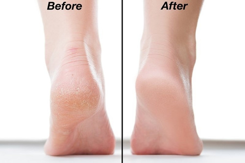 Exfoliadora Piedra Removedor De Vello Talones Cuerpo