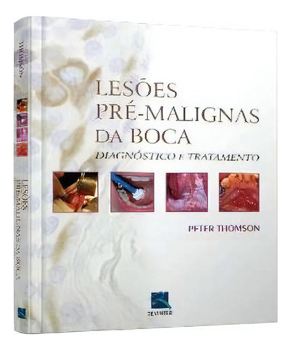 Lesões Pré-malignas Da Boca - Diagnóstico E Tratamento, De Thomson,peter. Editora Thieme Revinter Em Português