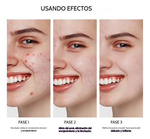 Suero De Ácido Azelaico De Crema Esencia Facial Exfoliante