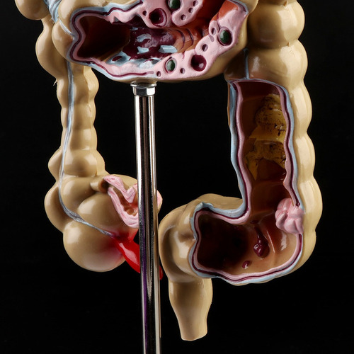 Para Para Modelo De Intestino Grueso Con Lesión De Colon