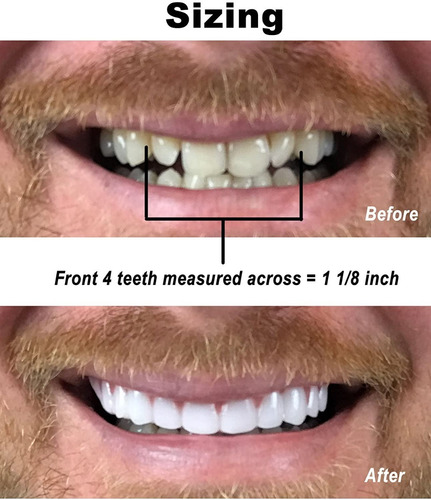 Dientes Articiales