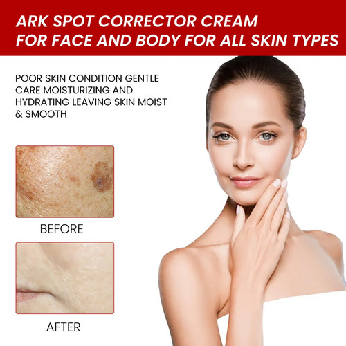 C Eliminador De Manchas Oscuras, Melasma, Pecas, Sol, Crema