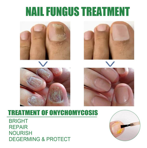 - Solución Contaminante Para El Cuidado De Las Uñas, 30 Ml