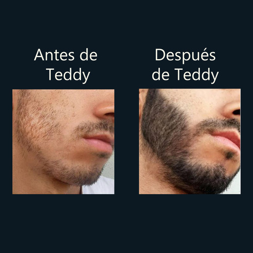 Minoxidil Teddy Beard P/ Barba & Cabello Dos Frascos Al 10%