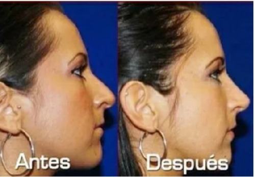 Imagen 10 de 10 de Corrector Nasal Incluye 6 Repingador + Extractor