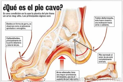 Plantillas Pie Plano Valgo Varo Infantiles