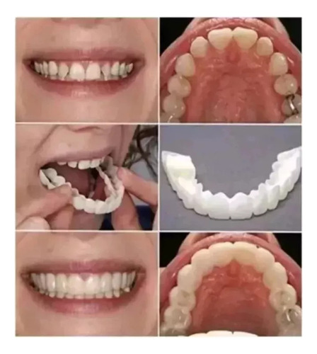 Sorriso Dentes Falsos Folheados W En La Parte Superior/infer