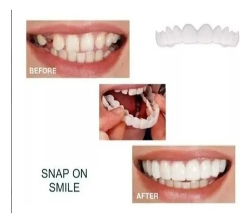 Prótesis Dentadura Postizo Snap On Smile Superior E Inferior