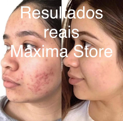 Vittacyd Xt 1% Clareador Facial Para Acne E Melasma 25g Todo Tipo De Pele Noite
