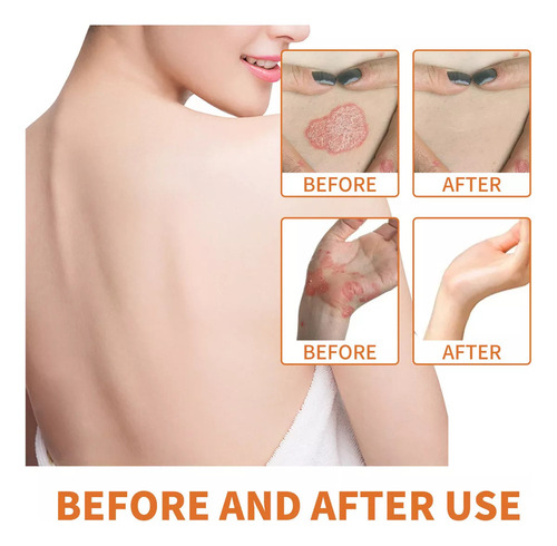 5×crema Para Tratamientos Psoriasis Con Venenos Abeja