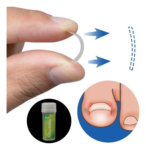 Set De Corrección De Uñas Encarnadas, Tratamiento Para Uñas