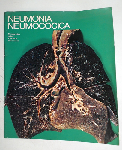 Neumonia Neumococica - Wittner, Murray