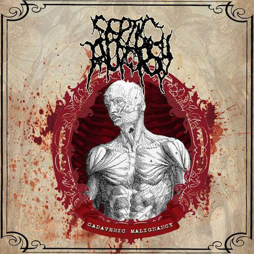 Cd Septic Autopsy - Cadaveric Malignancy 