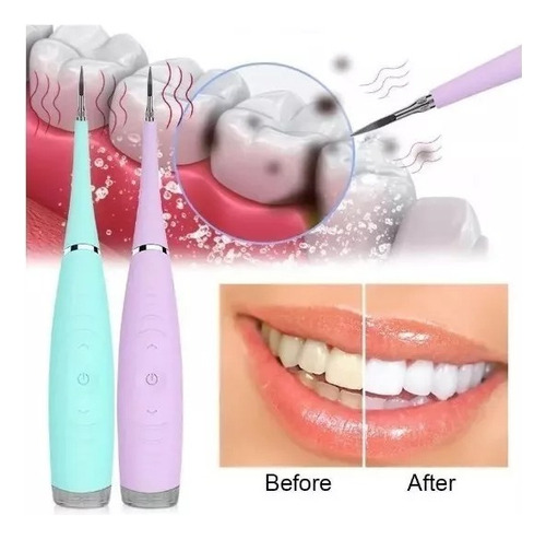 Limpiador Dental Ultrasónico Inalámbrico Usb Sarro Dientes